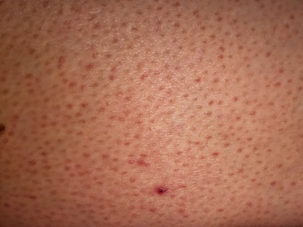 skin-bumps кератоз