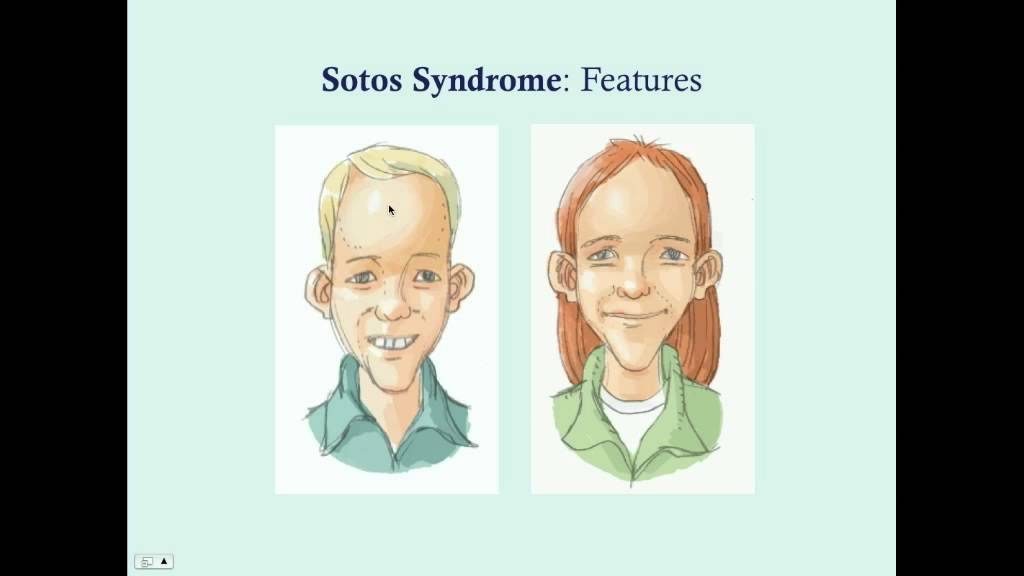 Проявления синдрома Сотоса