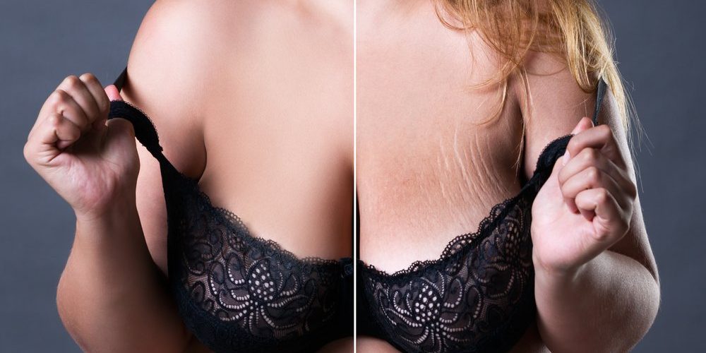 o растяжки на груди