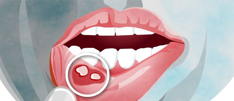 стоматит стоматит